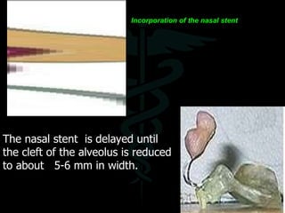 The nasal stent  is delayed until the cleft of the alveolus is reduced to about  5-6 mm in width.  Incorporation of the na...