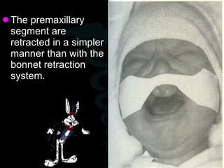 <ul><li>The premaxillary segment are retracted in a simpler manner than with the bonnet retraction system.  </li></ul>