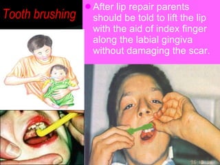 Tooth brushing <ul><li>After lip repair parents should be told to lift the lip with the aid of index finger along the labi...