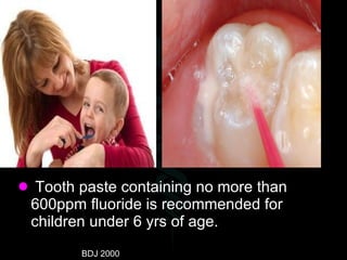 <ul><li>Tooth paste containing no more than 600ppm fluoride is recommended for children under 6 yrs of age. </li></ul>BDJ ...