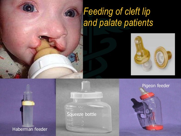 pigeon feeder cleft palate