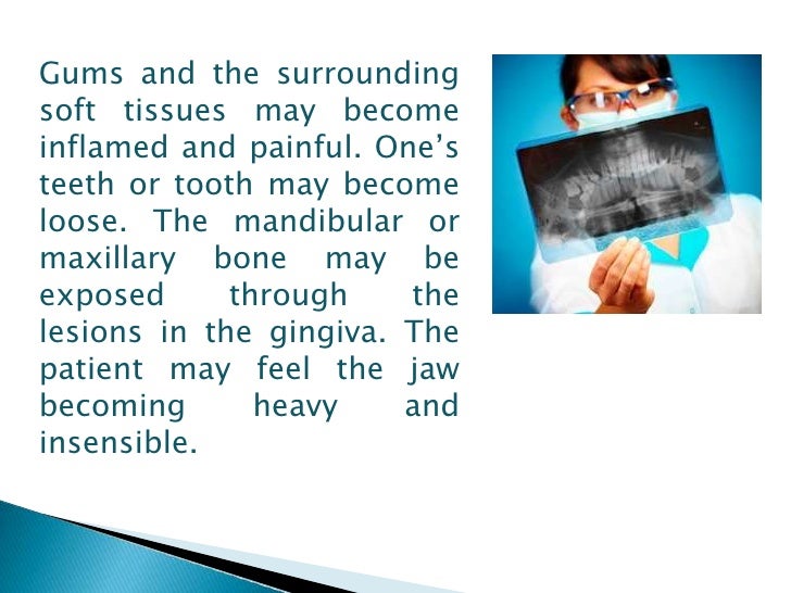 Fosamax and osteonecrosis of the jaw