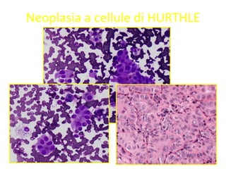 Neoplasia a cellule di HURTHLE
 