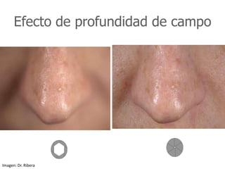 Efecto de profundidad de campo
Imagen: Dr. Ribera
 