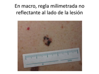 En macro, regla milimetrada no
reflectante al lado de la lesión
 