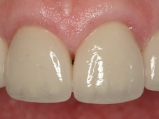 Fotocurado Dental