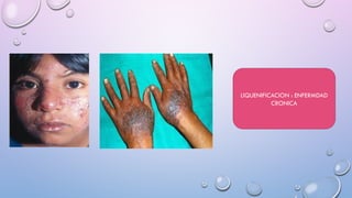 Solar Photodermatosis Comprehensive Overview of Photodermatosis and UV Radiation Effects on ...