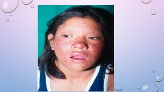 Solar Photodermatosis Comprehensive Overview of Photodermatosis and UV Radiation Effects on ...