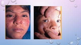 Solar Photodermatosis Comprehensive Overview of Photodermatosis and UV Radiation Effects on ...