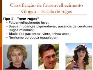 Classificação de fotoenvelhecimento Glogau – Escala de rugas Tipo I – “sem rugas” - Fotoenvelhecimento leve; - Suave mudanças pigmentares, ausência de ceratoses; - Rugas mínimas; - Idade dos pacientes- vinte, trinta anos; - Nenhuma ou pouca maquiagem. 