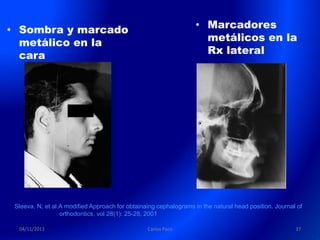 • Sombra y marcado                                                 • Marcadores
  metálico en la                                                     metálicos en la
  cara                                                               Rx lateral




 Sleeva, N; et al.A modified Approach for obtainaing cephalograms in the natural head position. Journal of
                  orthodontics, vol 28(1): 25-28, 2001

  04/11/2011                                     Carlos Paco                                           37
 