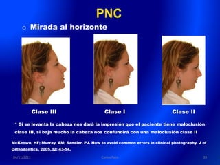o Mirada al horizonte




             Clase III                      Clase I                          Clase II

 * Si se levanta la cabeza nos dará la impresión que el paciente tiene maloclusión
 clase III, si baja mucho la cabeza nos confundirá con una maloclusión clase II

McKeown, HF; Murray, AM; Sandler, PJ. How to avoid common errors in clinical photography. J of
Orthodontics, 2005,32: 43-54.

04/11/2011                                 Carlos Paco                                      39
 