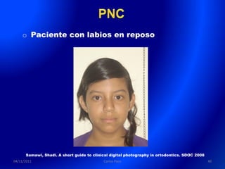 o Paciente con labios en reposo




      Samawi, Shadi. A short guide to clinical digital photography in ortodontics. SDOC 2008
04/11/2011                                 Carlos Paco                                         40
 
