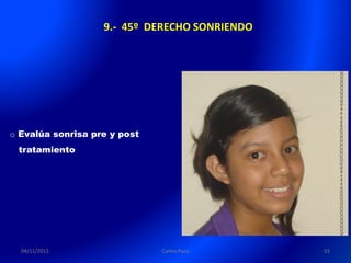 9.- 45º DERECHO SONRIENDO




o Evalúa sonrisa pre y post
 tratamiento




  04/11/2011                  Carlos Paco      61
 
