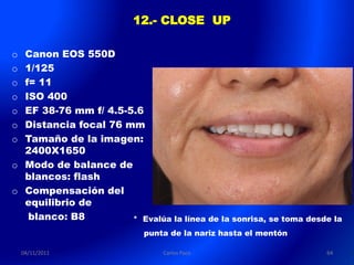 12.- CLOSE UP

o Canon EOS 550D
o 1/125
o f= 11
o ISO 400
o EF 38-76 mm f/ 4.5-5.6
o Distancia focal 76 mm
o Tamaño de la imagen:
  2400X1650
o Modo de balance de
  blancos: flash
o Compensación del
  equilibrio de
   blanco: B8         * Evalúa la línea de la sonrisa, se toma desde la
                            punta de la nariz hasta el mentón

    04/11/2011                  Carlos Paco                        64
 