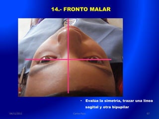 14.- FRONTO MALAR




                         •   Evalúa la simetría, trazar una línea
                             sagital y otra bipupilar
04/11/2011         Carlos Paco                               67
 