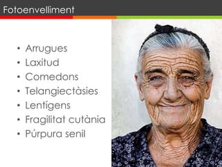 • Arrugues
• Laxitud
• Comedons
• Telangiectàsies
• Lentígens
• Fragilitat cutània
• Púrpura senil
Fotoenvelliment
 