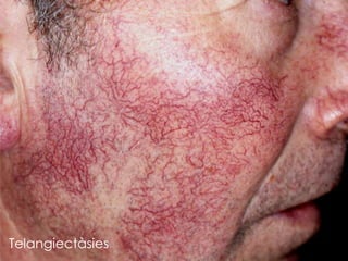 Telangiectàsies
 