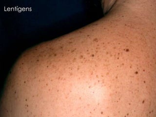 Lentígens
 