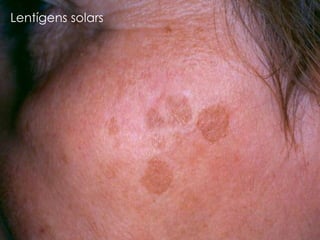 Lentígens solars
 