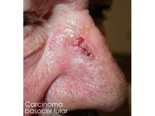 Carcinoma
basocel·lular
 