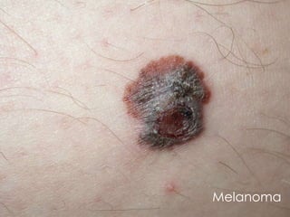 Melanoma
 