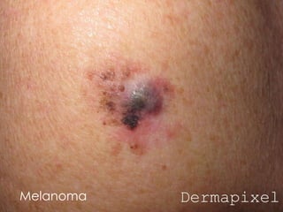 Melanoma
 