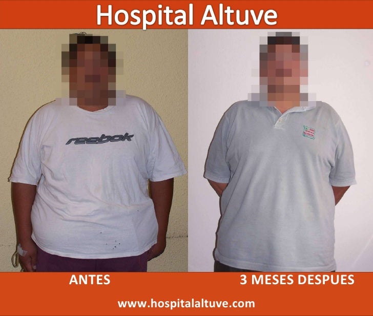 Antes y Despues de un Bypass Antes y Despues de un Bypass