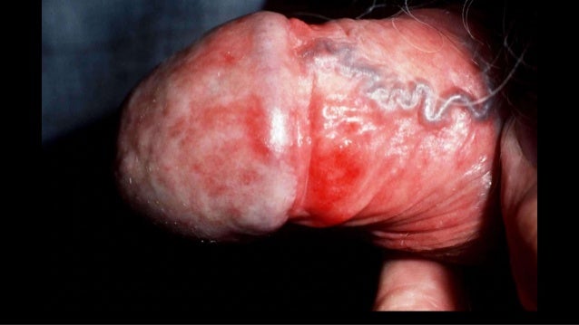 Pictures of STDs: Herpes, Genital Warts, Gonorrhea, STD ...