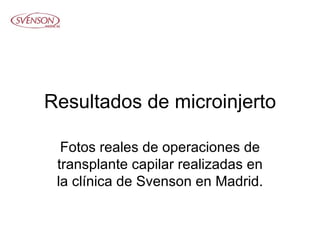 Resultados de microinjerto Fotos reales de operaciones de transplante capilar realizadas en la clínica de Svenson en Madrid. 