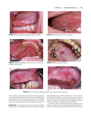 CAPÍTULO 2      Condições Ulcerativas          23




FIGURA 2-3 Úlcera aguda na língua associada à anestesia.             FIGURA 2-5 Úlcera crônica da lateral da língua.




FIGURA 2-4 Úlcera associada ao calor excessivo do material de        FIGURA 2-6 Úlcera crônica do palato.
moldagem hidrocolóide.




                          FIGURA 2-7 A e B, Úlceras e eritema causados pela borda da prótese removível.

trada na língua. Outra úlcera crônica de aparência agourenta,        predominantemente, neutróﬁlos (Figura 2-9). A base da úlcera
caracteristicamente observada no palato duro, é conhecida como       contém capilares dilatados e, com o passar do tempo, forma-se
sialometaplasia necrosante. Ela está associada à necrose isquêmica   um tecido de granulação. A regeneração do epitélio começa nas
induzida por trauma de uma glândula salivar menor e a cicatri-       margens da úlcera, com a proliferação das células sobre a base do
zação ocorre espontaneamente em várias semanas (Capítulo 8).         tecido de granulação e por baixo do coágulo de ﬁbrina.
                                                                         As úlceras crônicas apresentam uma base de tecido de gra-
Histopatologia. As úlceras agudas apresentam a perda do epitélio     nulação, com uma cicatriz encontrada mais profundamente no
superﬁcial que é substituído por uma rede de ﬁbrina contendo,        tecido. Um inﬁltrado de células inﬂamatórias misto é observado.
 