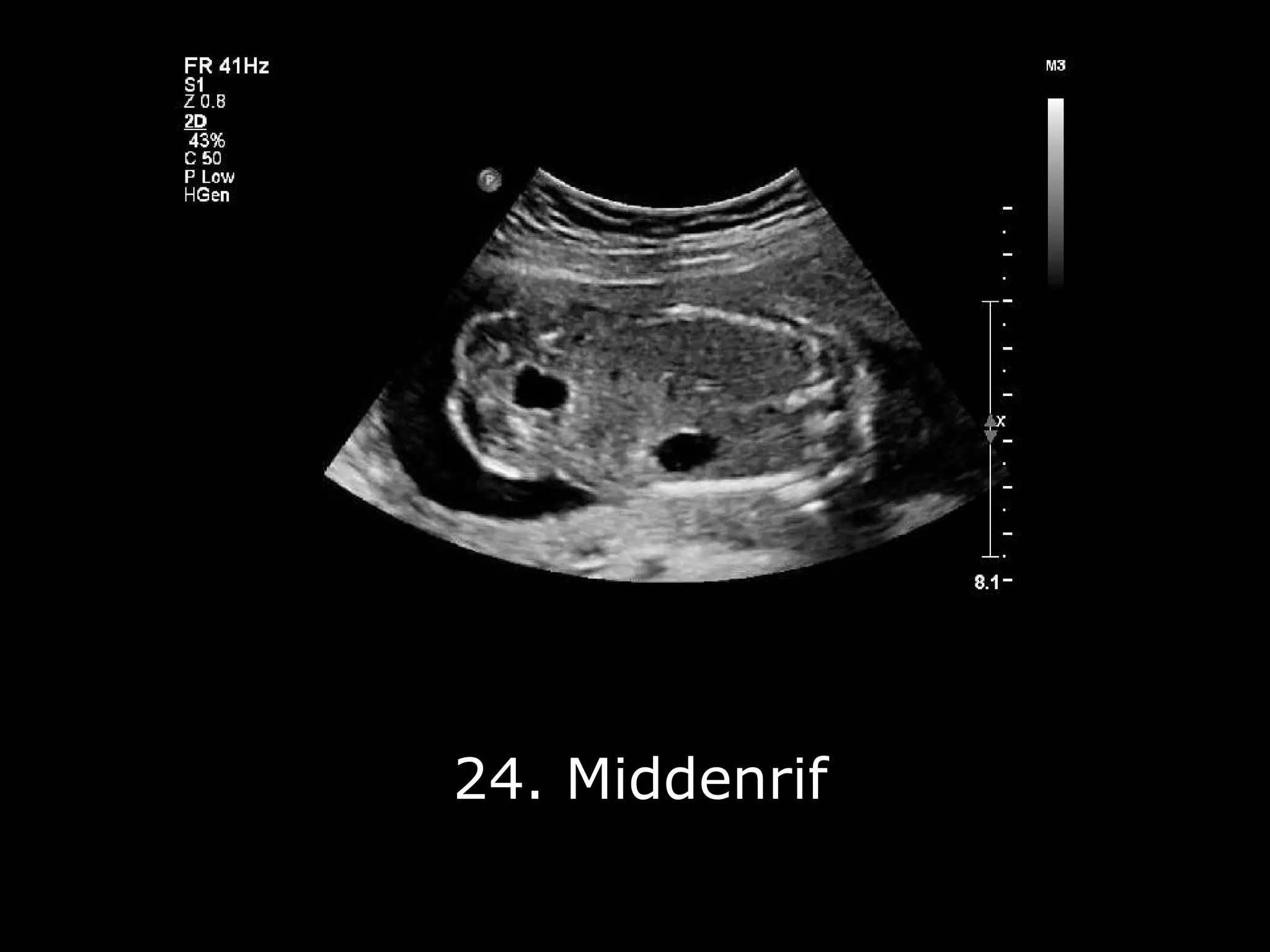 Fotoserie 20-weken echoscreening | PPT | Free Download