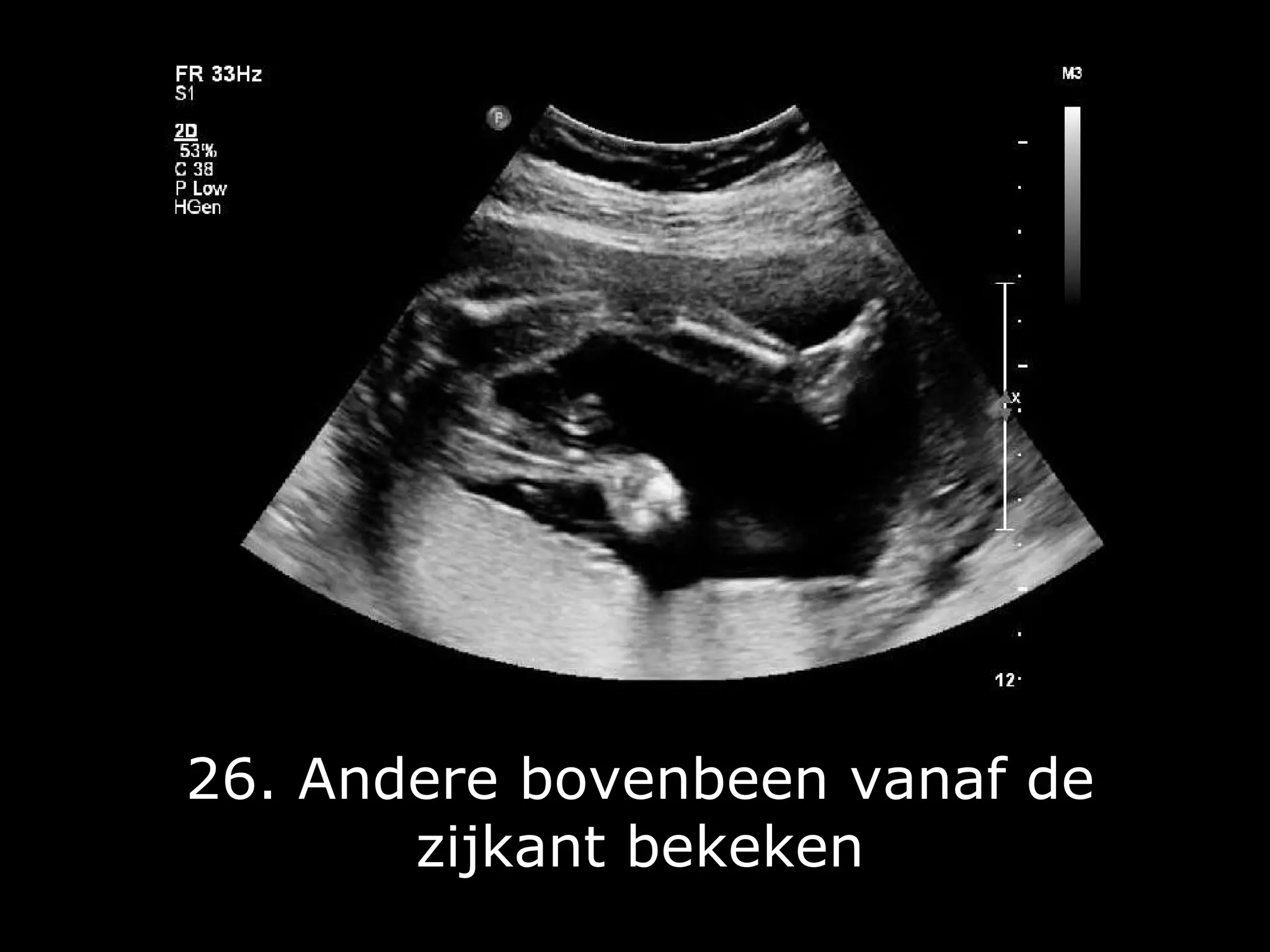 20 Weken Echo 2 Bloedvaten Navelstreng