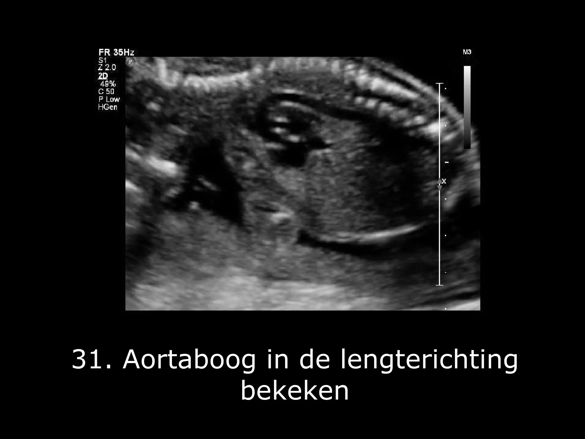 Fotoserie 20-weken echoscreening | PPT | Free Download