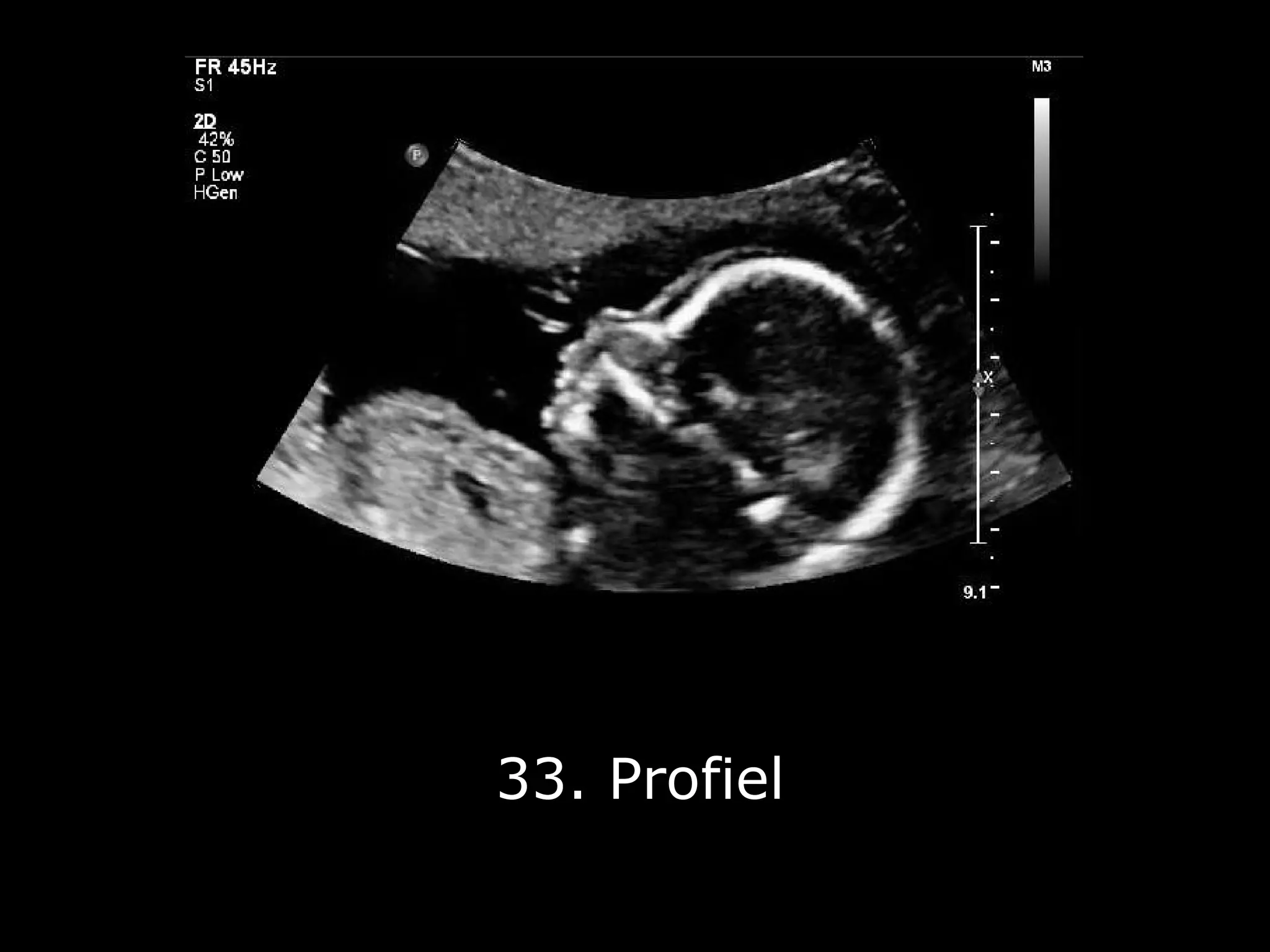 Fotoserie 20-weken echoscreening | PPT | Free Download