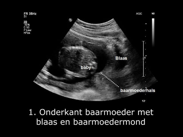Fotoserie 20-weken echoscreening | PPT | Free Download