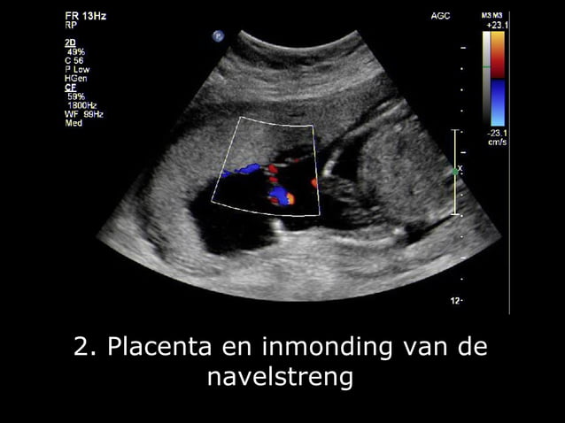 Fotoserie 20-weken echoscreening | PPT | Free Download