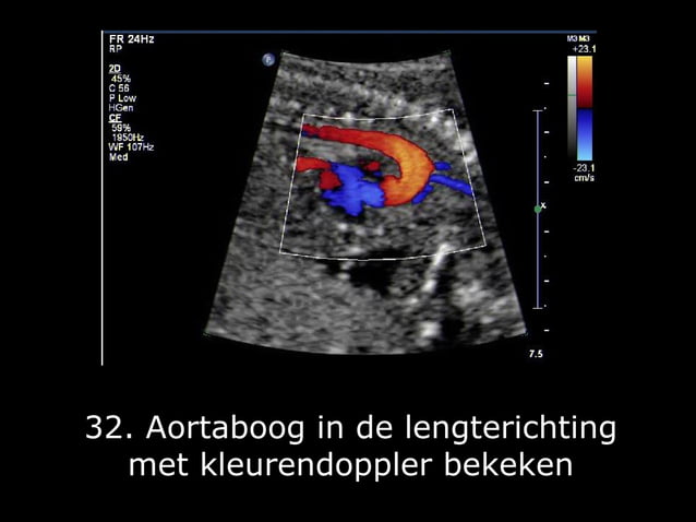 Fotoserie 20-weken echoscreening | PPT | Free Download
