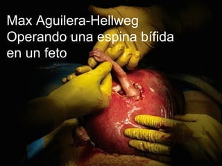 Max Aguilera-Hellweg Operando una espina bífida  en un feto 