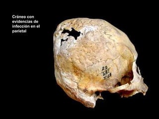 Cráneo con evidencias de infección en el parietal 