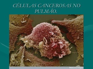 CÉLULAS CANCEROSAS NO PULMÃO.  
