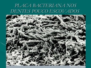PLACA BACTERIANA NOS DENTES POUCO ESCOVADOS   