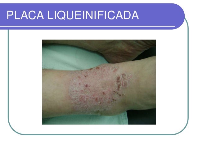 La crema y el ungüento de atopicheskogo de la dermatitis a