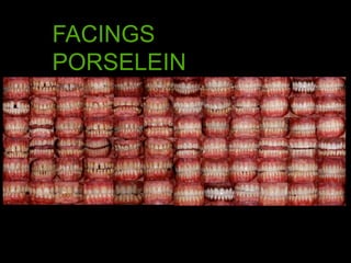 FACINGS
PORSELEIN
 