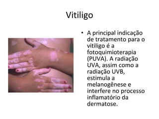 Vitiligo A principal indicação de tratamento para o vitiligo é a fotoquimioterapia (PUVA). A radiação UVA, assim como a radiação UVB, estimula a melanogênese e interfere no processo inflamatório da dermatose.  