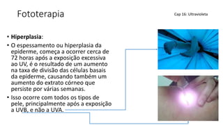 Fototerapia
• Hiperplasia:
• O espessamento ou hiperplasia da
epiderme, começa a ocorrer cerca de
72 horas após a exposição excessiva
ao UV, é o resultado de um aumento
na taxa de divisão das células basais
da epiderme, causando também um
aumento do extrato córneo que
persiste por várias semanas.
• Isso ocorre com todos os tipos de
pele, principalmente após a exposição
a UVB, e não a UVA.
Cap 16: Ultravioleta
 