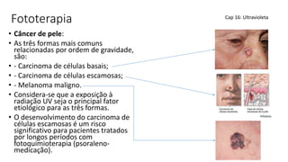 Fototerapia
• Câncer de pele:
• As três formas mais comuns
relacionadas por ordem de gravidade,
são:
• - Carcinoma de células basais;
• - Carcinoma de células escamosas;
• - Melanoma maligno.
• Considera-se que a exposição à
radiação UV seja o principal fator
etiológico para as três formas.
• O desenvolvimento do carcinoma de
células escamosas é um risco
significativo para pacientes tratados
por longos períodos com
fotoquimioterapia (psoraleno-
medicação).
Cap 16: Ultravioleta
 