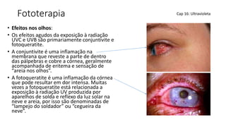 Fototerapia
• Efeitos nos olhos:
• Os efeitos agudos da exposição à radiação
UVC e UVB são primariamente conjuntivite e
fotoqueratite.
• A conjuntivite é uma inflamação na
membrana que reveste a parte de dentro
das pálpebras e cobre a córnea, geralmente
acompanhada de eritema e sensação de
“areia nos olhos”.
• A fotoqueratite é uma inflamação da córnea
que pode resultar em dor intensa. Muitas
vezes a fotoqueratite está relacionada a
exposição à radiação UV produzida por
aparelhos de solda e reflexo da luz solar na
neve e areia, por isso são denominadas de
“lampejo do soldador” ou “cegueira da
neve”.
Cap 16: Ultravioleta
 