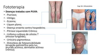 Fototerapia
• Doenças tratadas com PUVA:
• - Psoríase;
• - Vitiligo;
• - Eczema;
• - Líquen plano;
• - Doença enxerto contra hospedeiro;
• - Pitríase Liquenóide Crônica;
• - Linfoma cutâneo de células T
(micose fungóide);
• - Urticária pigmentosa;
• - Distúrbios de fotosensibilidade
(erupção polimórfica pela luz,
prurido actínico, dermatite actínea
crônica).
Cap 16: Ultravioleta
 