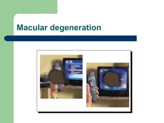Macular degeneration 